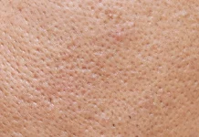 Creme care conțin acid salicilic, produsul cel mai eficient pentru îndepărtarea punctelor negre