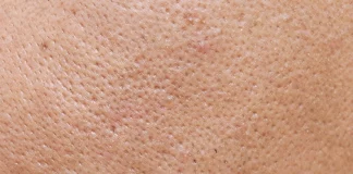 Creme care conțin acid salicilic, produsul cel mai eficient pentru îndepărtarea punctelor negre